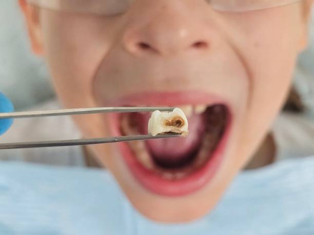 Emergency Dental Filling Replacement in MN